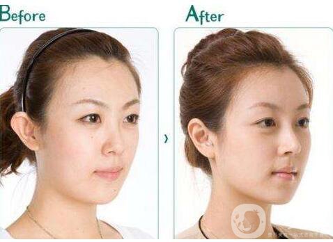 自體軟骨隆鼻尖,價格