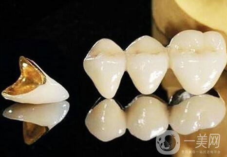 黃金烤瓷牙多少錢一顆？黃金烤瓷牙價格詳解