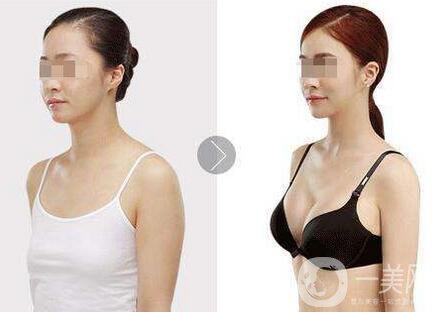 隆胸曼托假體多少錢？曼托假體價格詳解