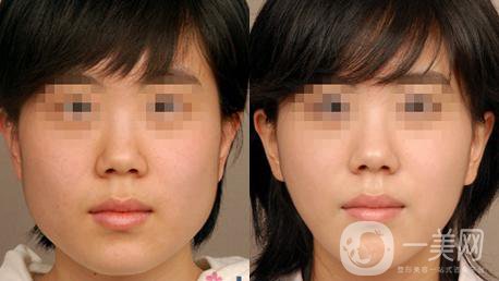 咬肌切除手術(shù)多少錢？手術(shù)*嗎？