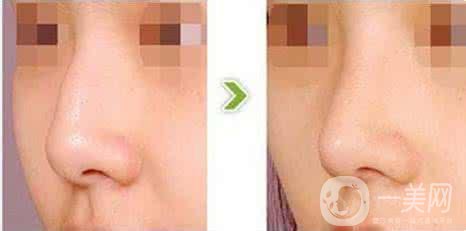 駝峰鼻矯正價錢一般是多少？