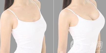 曼托假體豐胸價格大概多少錢？