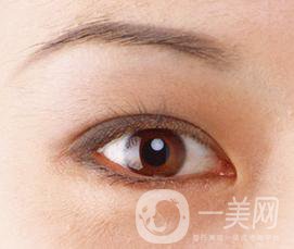 生物焊接雙眼皮是什么？有什么特點？