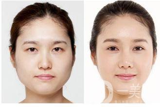 生物焊接雙眼皮是什么？有什么特點？