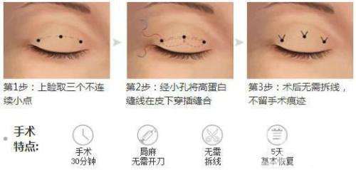 三點(diǎn)式雙眼皮*果一般能撐幾年？