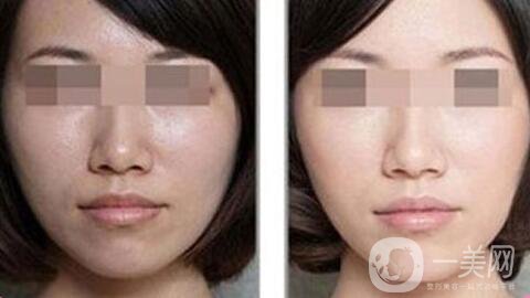 光子嫩膚做一次多少錢、光子嫩膚價格詳解