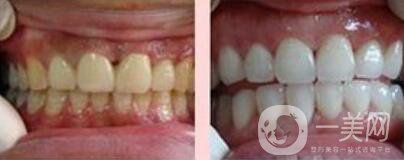 四環(huán)素牙如何變白、四環(huán)素牙怎么調(diào)節(jié)？