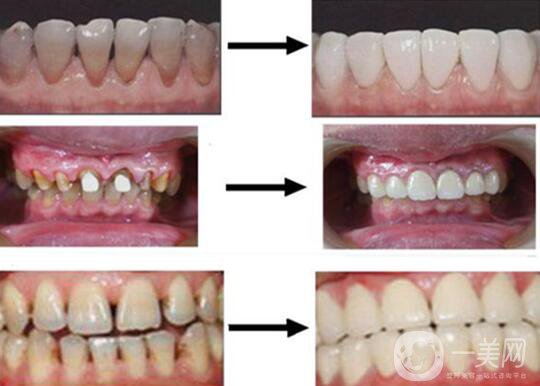 烤瓷牙的材料有哪些？烤瓷牙*果如何