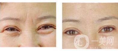 眉間皺紋如何去除？眉間川字紋怎么才能去掉