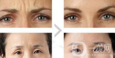眉間皺紋如何去除？眉間川字紋怎么才能去掉