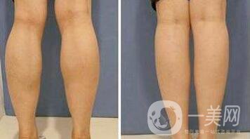 *要多少錢？注射*價格詳細(xì)介紹