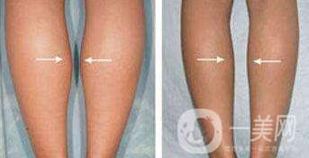 *要多少錢？注射*價格詳細(xì)介紹