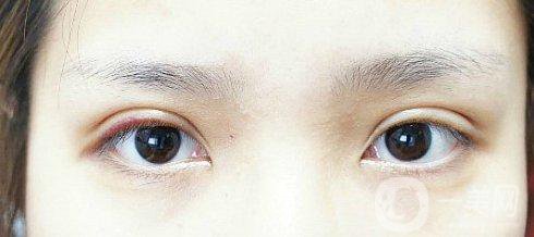 眼睛埋線幾年后的危害有些什么？