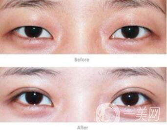 焊接雙眼皮*果怎么樣？焊接雙眼皮有什么缺點