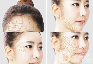 *面部提升術(shù)詳細(xì)介紹？**果怎么樣