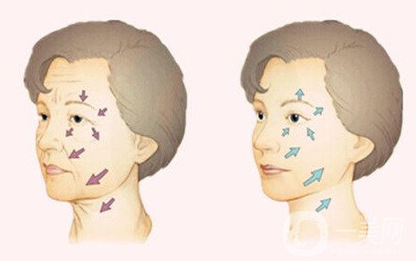 小切口拉皮除皺術(shù)*果一般能維持幾年？