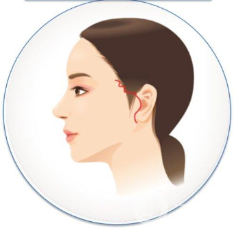 小切口拉皮除皺術(shù)*果一般能維持幾年？