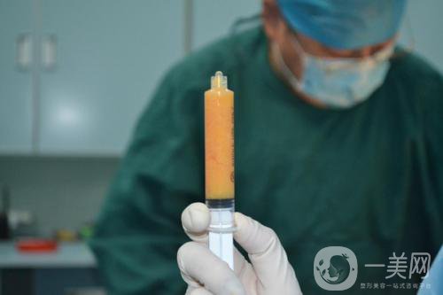 自體脂肪臉部填充*果可以維持多久？