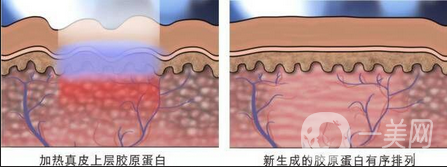 做像素激光調(diào)節(jié)痘疤一般多少錢(qián)？