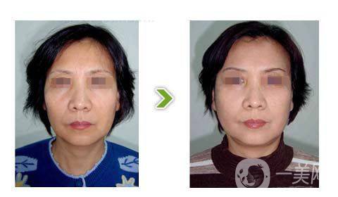 光子嫩膚的*果前后有什么變化？