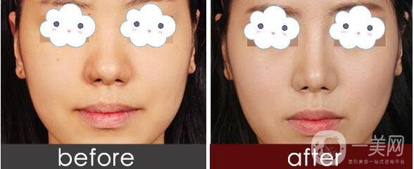 瑞蘭玻尿酸,價格