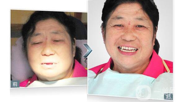 深圳,種植牙,價格