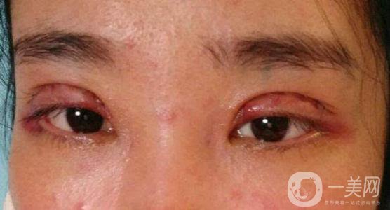 做完韓式三點雙眼皮之后眼睛會腫嗎？