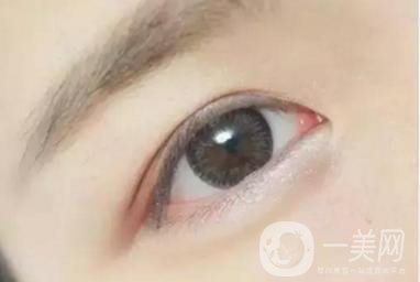 做完韓式三點雙眼皮之后眼睛會腫嗎？