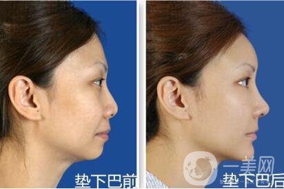 墊下巴,恢復(fù)時間