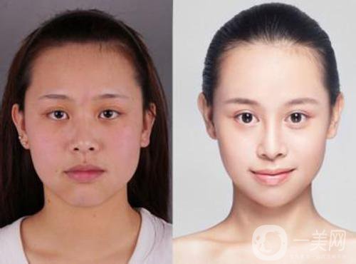 改臉型手術(shù)一般多少錢 價格詳情