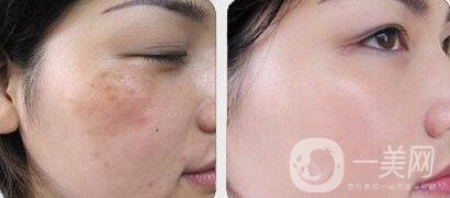 如何去蝴蝶斑、去蝴蝶斑用什么方法好？