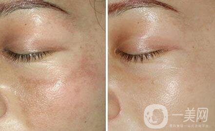 如何去蝴蝶斑、去蝴蝶斑用什么方法好？