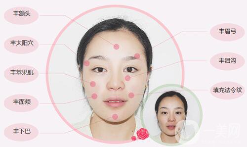 自體脂肪臉部填充*果可以維持多久？