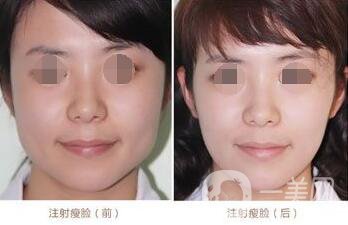 *一針要多少錢 正規(guī)醫(yī)院*價格貴嗎