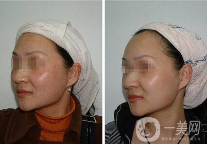 怎樣去除手上的老年斑 老年斑怎樣去除