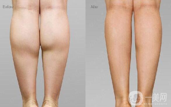 詳細(xì)介紹**到底有沒有副作用