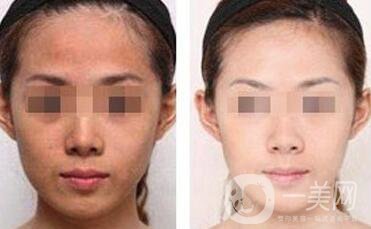 光子嫩膚價(jià)格是多少 光子嫩膚多少錢一次