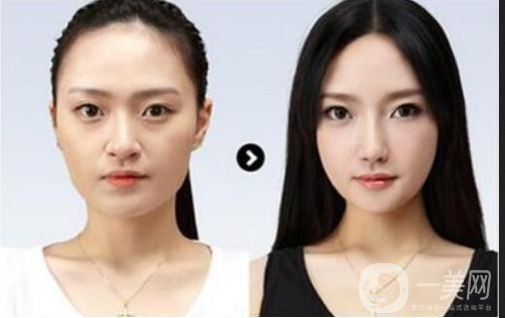 做完墊鼻梁硅膠*果能堅持幾年？