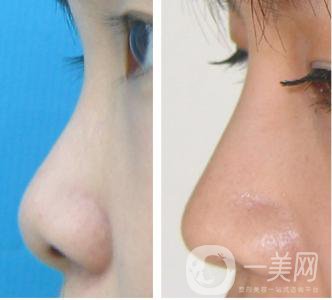 耳軟骨墊鼻尖手術(shù)做完需要多久恢復(fù)正常？