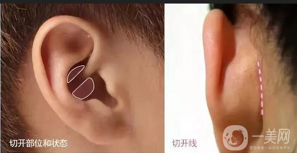 耳軟骨墊鼻尖手術(shù)做完需要多久恢復(fù)正常？