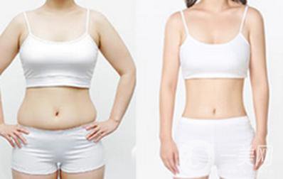 北京吸脂瘦腰減肥手術(shù)價(jià)錢是多少 價(jià)格一覽