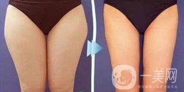 溶脂減肥手術(shù)的價(jià)格一般多少錢？