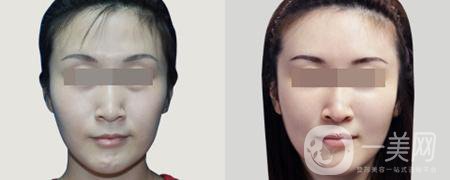 深圳做玻尿酸豐眉弓手術(shù)一般價(jià)格是多少