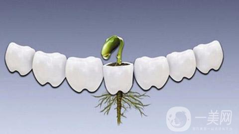 做一次種植牙的價格 費用貴嗎？