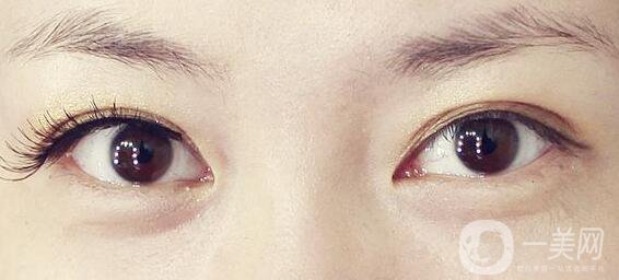 不開刀的雙眼皮是*的嗎？