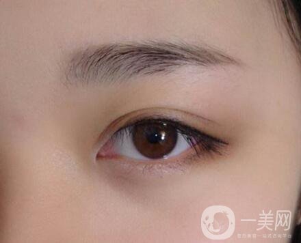 不開刀的雙眼皮是*的嗎？