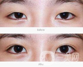 成都哪里割雙眼皮好 哪家醫(yī)院雙眼皮做的好