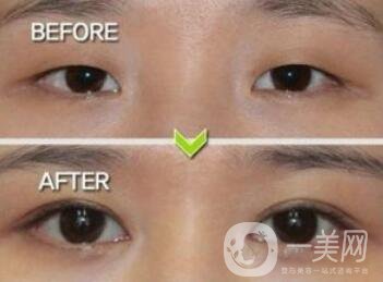 威海割雙眼皮多少錢？雙眼皮手術(shù)價格詳解