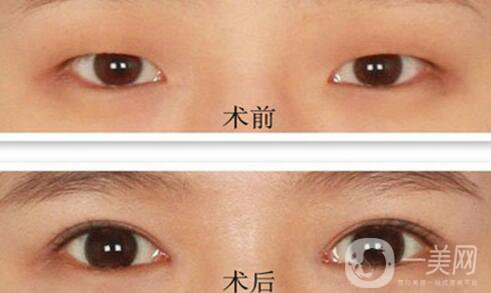 韓式*開眼角多少錢  韓式*開眼角恢復圖