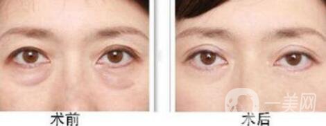 超聲法去眼袋怎么樣 超聲法祛眼袋多少錢